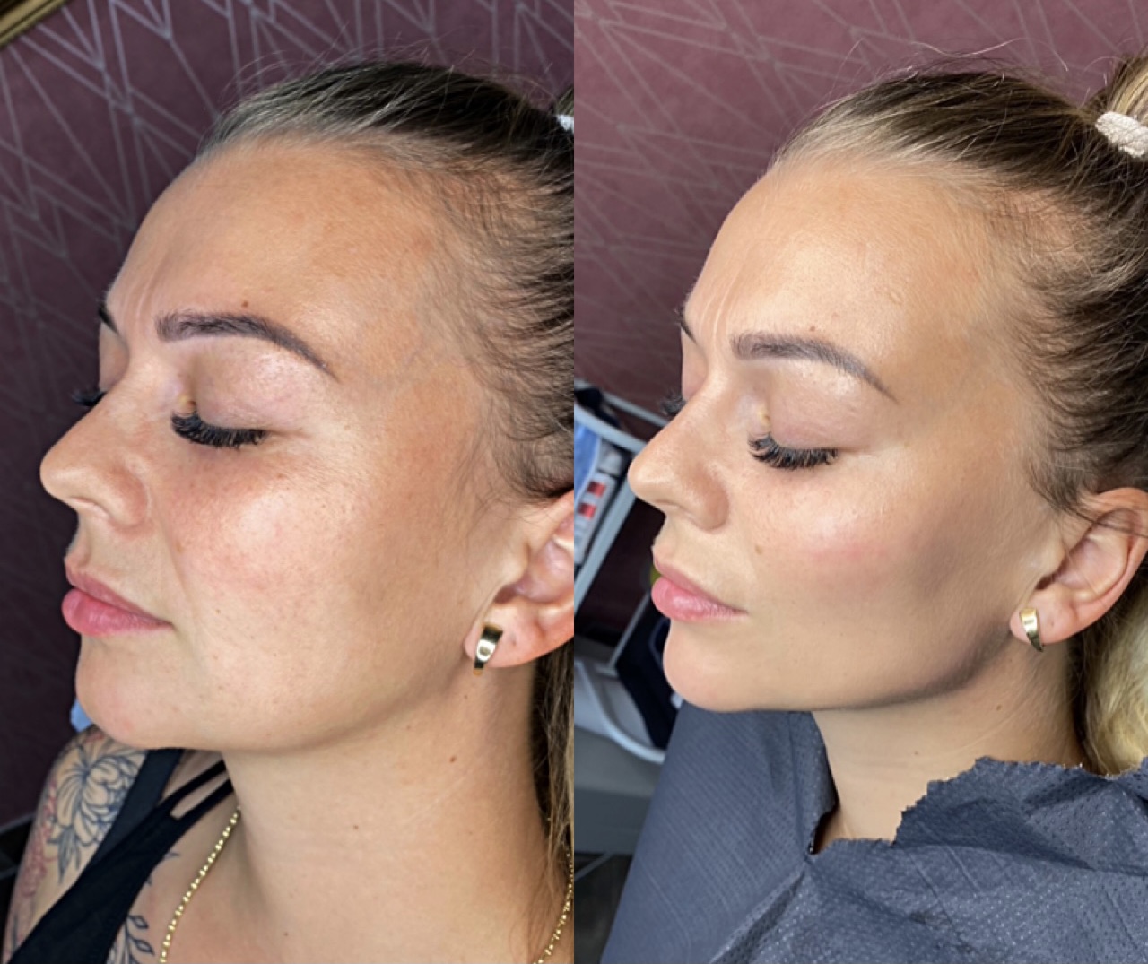 Efekt zabiegu Esthetic Care — Instagram